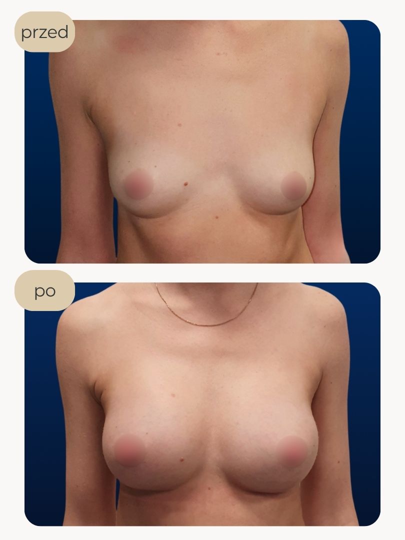 Powiększanie piersi implantami