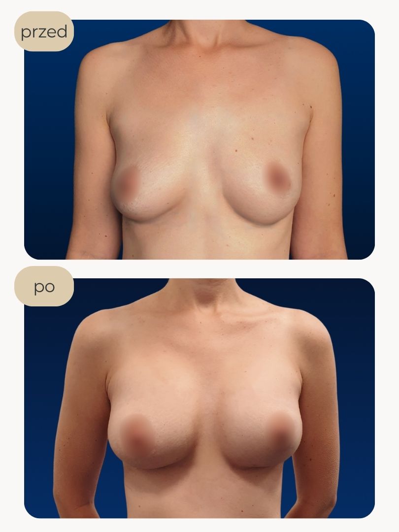 Powiększanie piersi implantami