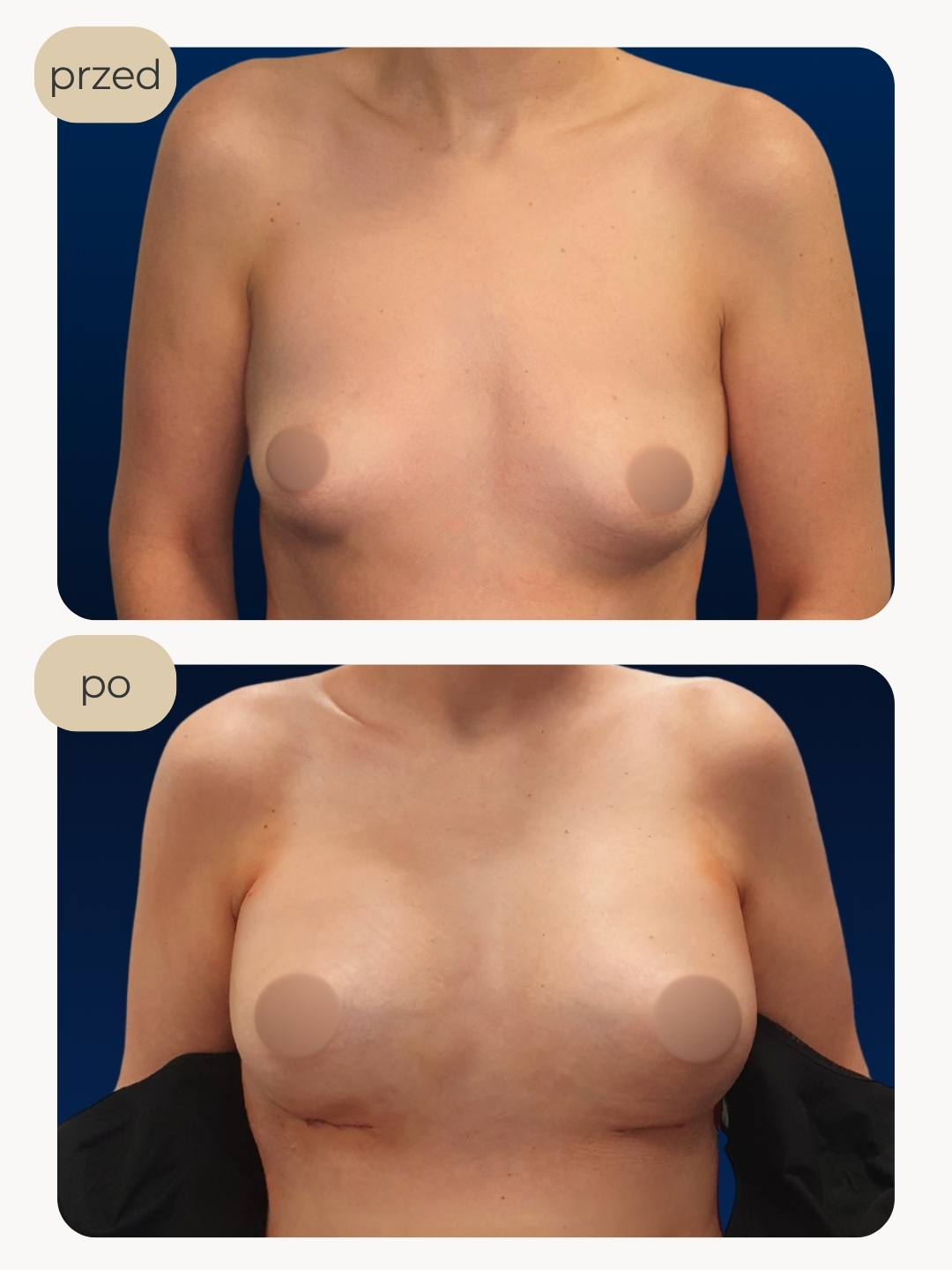 Powiększanie piersi implantami