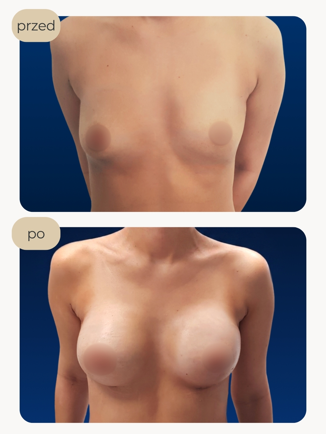 Powiększanie piersi implantami